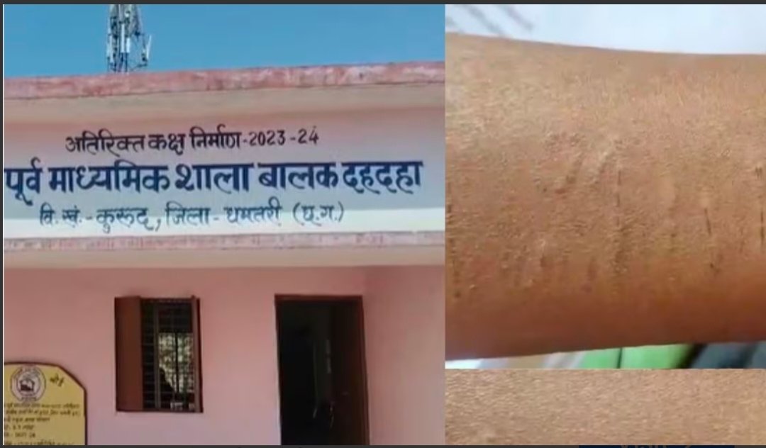 धमतरी में 35 सरकारी स्कूल के छात्रों ने कलाई काटी, ‘नकल करने’ की आशंका; जांच जारी 1 IMG 20260219 164502 धमतरी में 35 सरकारी स्कूल के छात्रों ने कलाई काटी, ‘नकल करने’ की आशंका; जांच जारी