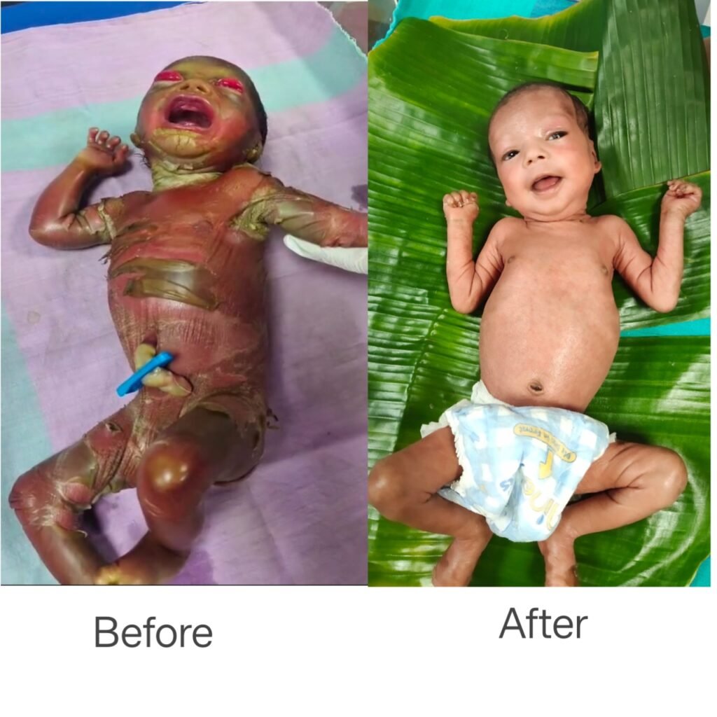 1007621469 सुदूर बीजापुर में चिकित्सा चमत्कार : अत्यंत दुर्लभ बीमारी से जूझते शिशु को बचाया